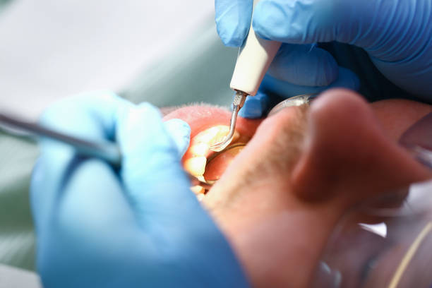 Best Emergency Root Canal Therapy in Bolingbrook, IL