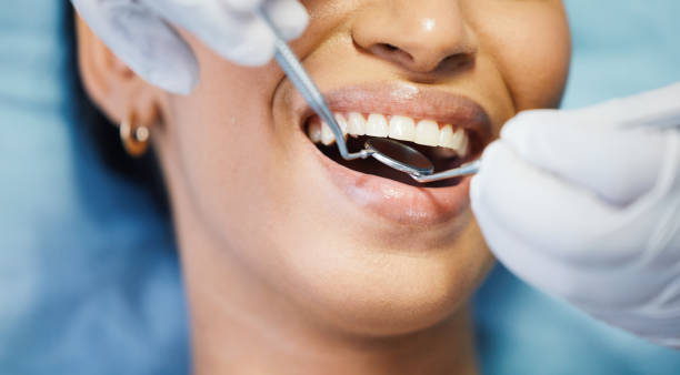 Best Knocked-Out Tooth (Avulsed Tooth) Treatment in Bolingbrook, IL