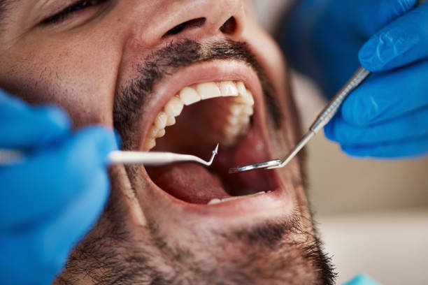Best Emergency Wisdom Tooth Extraction in Bolingbrook, IL